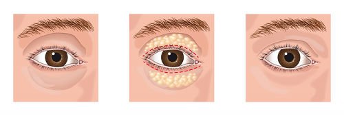 Blepharoplasty is the surgical removal of "eye bags"