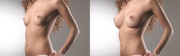 Lipotransfer in breast augmentation achieves highly natural results