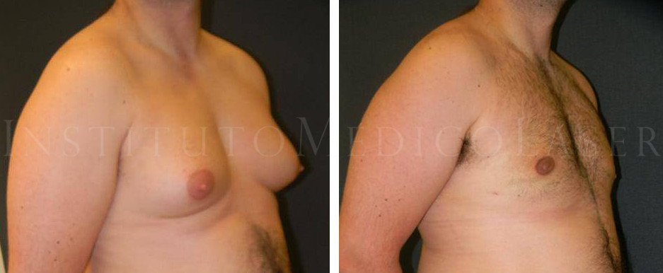 Before and after photographs of gynaecomastia treatment with Laser lipolysis