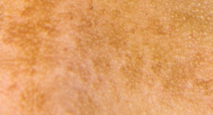 Melasma is a diffuse type of facial pigmentation 
