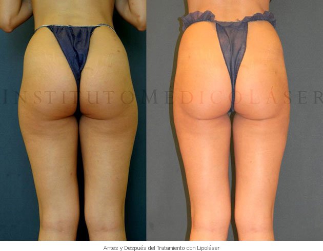 Lipolaser: Before and after