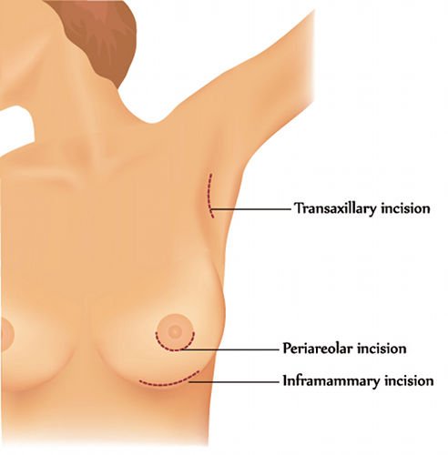 Access routes for breast implants