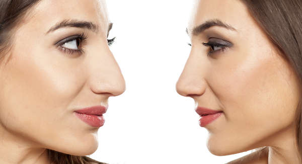 Before and after Rinostep to correct the nose