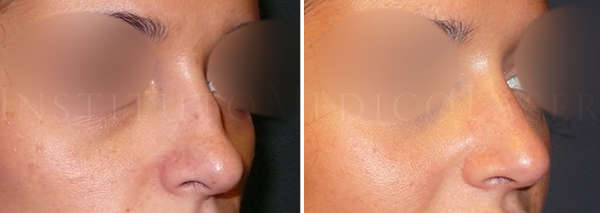 Before and after the infiltration of hyaluronic acid between the dorsum and the nasal tip