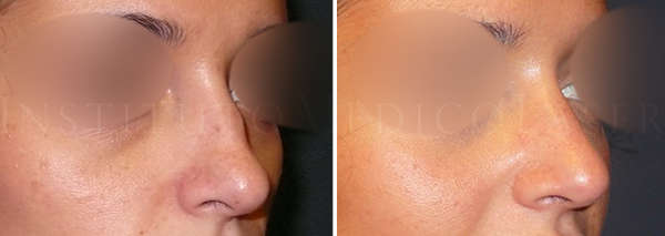 Before and after correction nose with hyaluronic acid