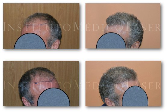 Before and after the hair transplant