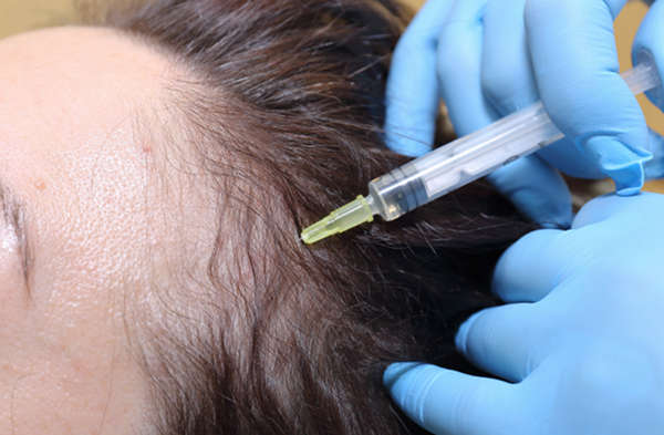micro punctures on the scalp