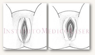 Clitoral hood reduction (before and after)