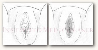 Understanding Clitoromegaly: Causes & Treatments