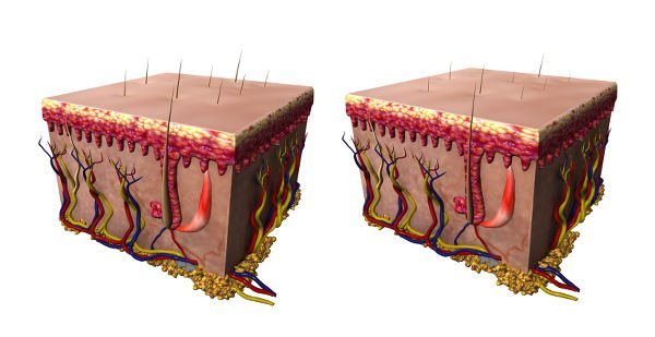 One of the characteristics of female pattern diffuse alopecia is hair miniaturisation