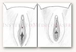 Hymen reconstruction (before and after)