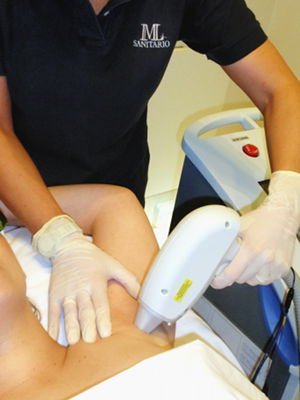 IML laser hair removal