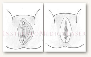 Laser reduction Labiaplasty (before and after)