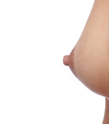 Lipotransfer to correct breast implants with unnatural results