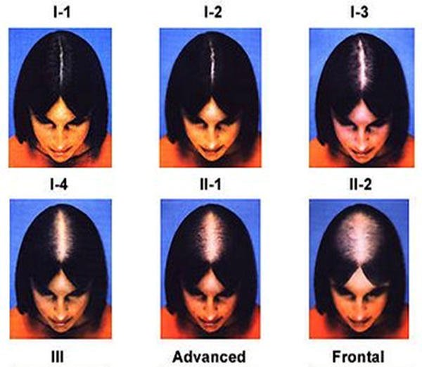 Ludwig scale. Degrees of evolution of diffuse female alopecia