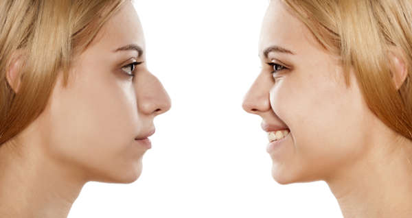 Rinostep corrects defects of the nose