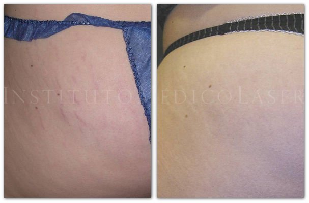 Stretch marks treatment: before and after