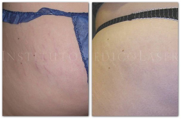 Striae Stretch Mark Repair Treatment IML exclusive