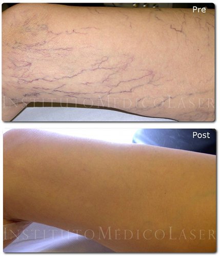 Before and after treatment of varicose veins