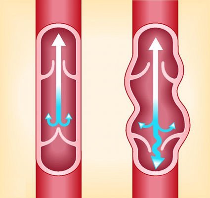 Venous valve failure causes an inverse flow of blood or reflux