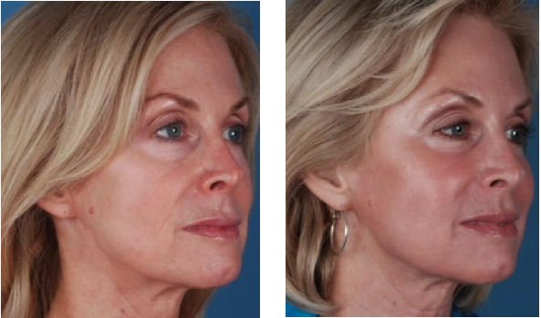 Elimination of blemishes, unification of tone and improved texture in the skin are some of the results of Blue Peel